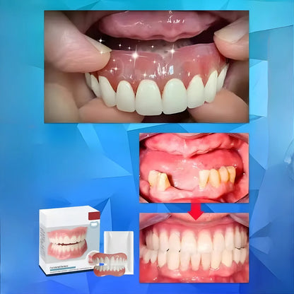 Cosmetic Denture Set Moldable Resin Upper & Lower
