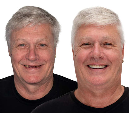 Cosmetic Denture Set Moldable Upper & Lower At-Home Fit