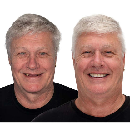 Denture Set Upper & Lower Flexible Cushion Grip