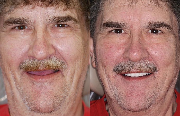 Full Denture Set Moldable Custom Fit Upper And Lower