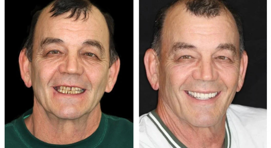 Full Denture Set Moldable Custom Fit Upper And Lower