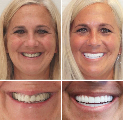 Full Denture Set Moldable Custom Fit Upper And Lower