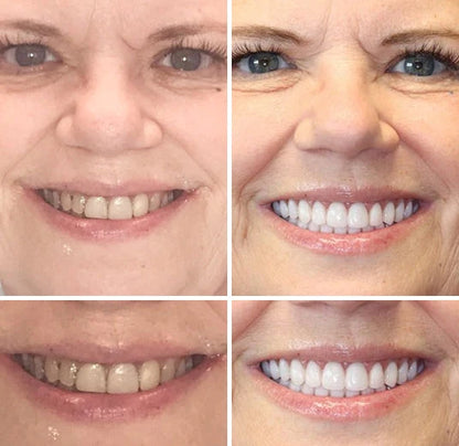 Full Denture Set Moldable Custom Fit Upper And Lower