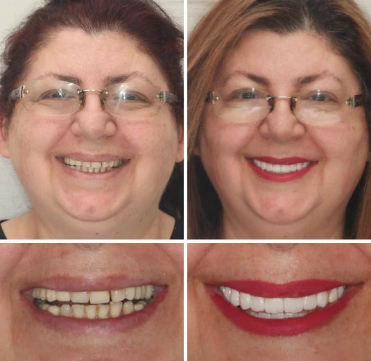 Full Denture Set Moldable Custom Fit Upper And Lower