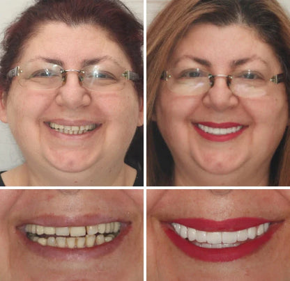 Full Denture Set Moldable Custom Fit Upper And Lower