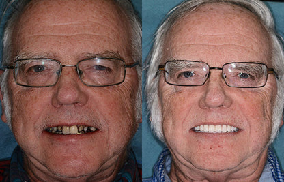 Full Denture Set Moldable Custom Fit Upper And Lower