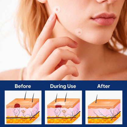 Skin Tag Remover Patches Gentle Non-Invasive Application